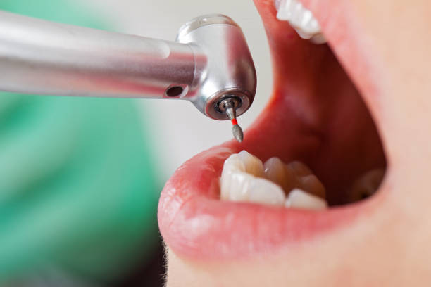 Best Chipped Tooth Repair Near Me  in Sandia Knolls, NM